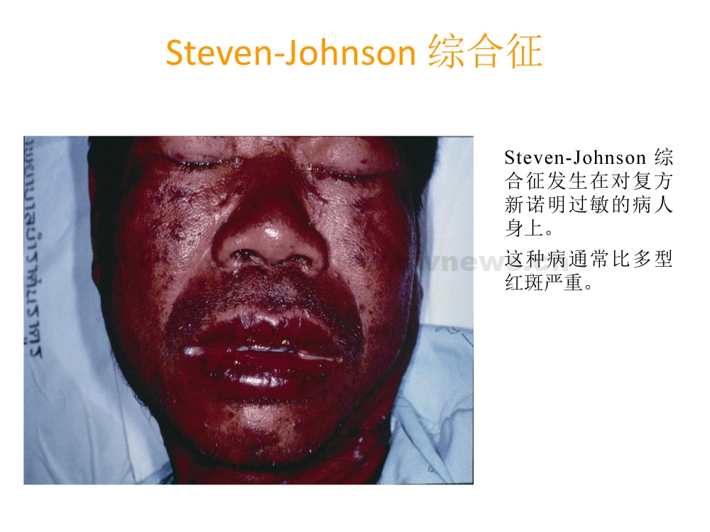 HIV/AIDS抗病毒治疗过程中的副作用监测和处理